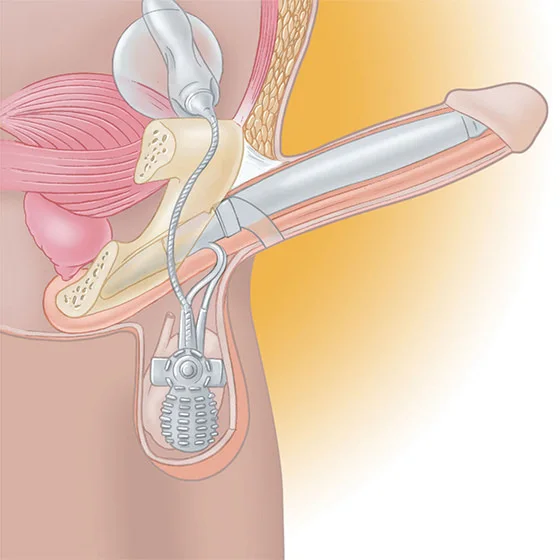 Dysfonction érectile | Urologie Steinberg