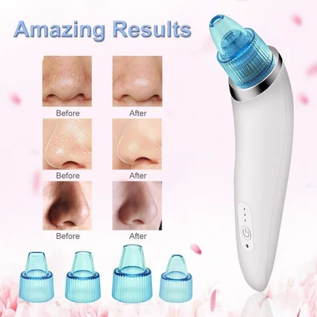 جهاز لشفط و إزالة الرؤوس السوداء