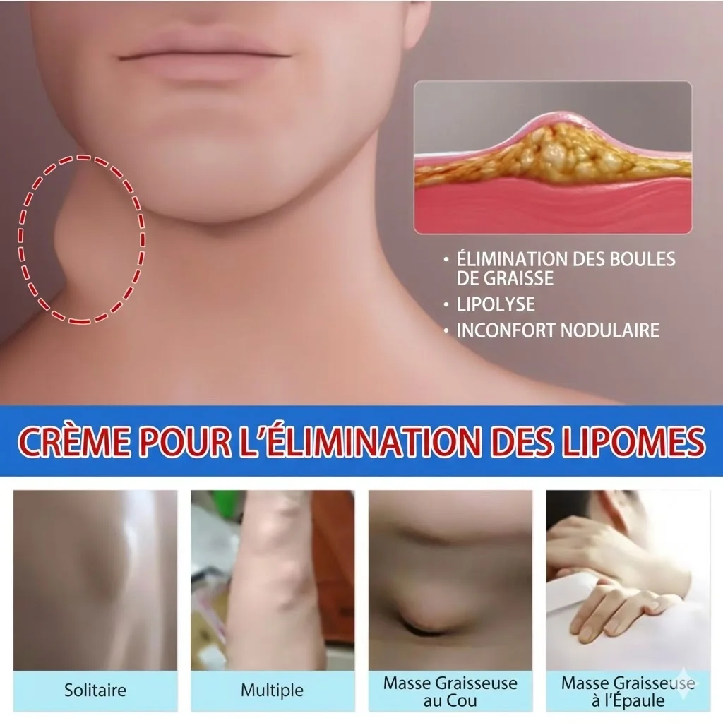 🌿💧Éliminez vos lipomes naturellement chez vous avec cette crème efficace 🧴✅