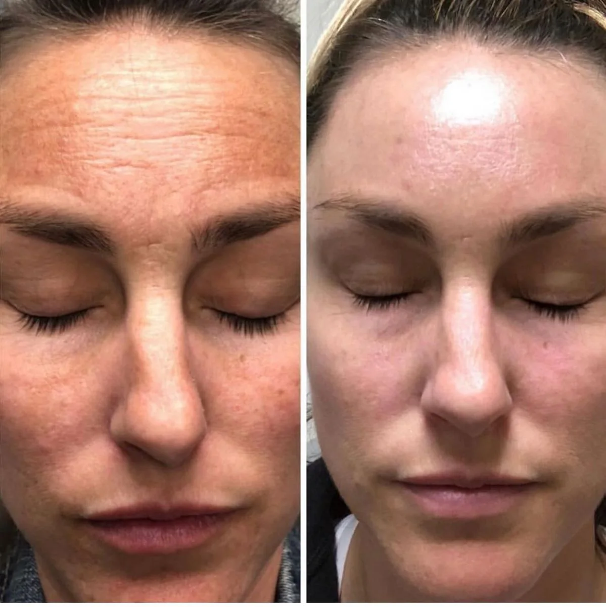 أداة شد و نحت الوجه   - THE ORIGINAL face lifting Tool