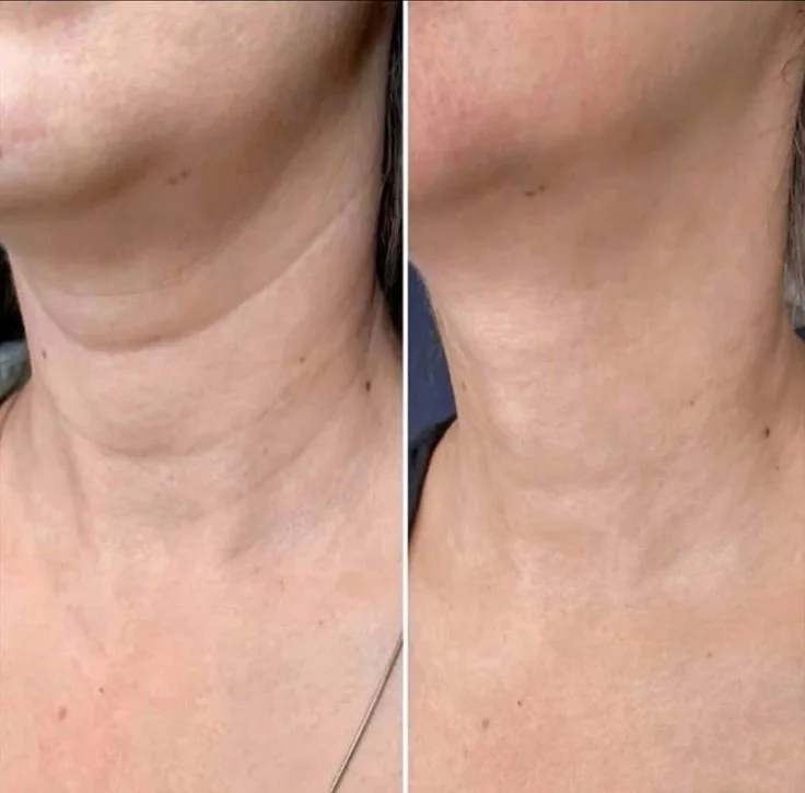 أداة شد و نحت الوجه   - THE ORIGINAL face lifting Tool