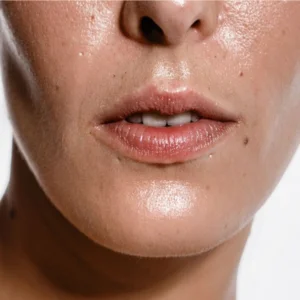 Peau Grasse (avec peu d'imperfections)