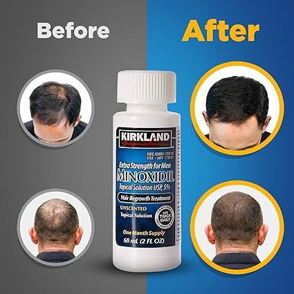 كيركلاند مينوكسيديل  Minoxidil