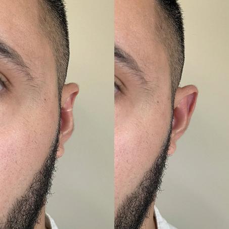 Pince correctrice d'oreilles