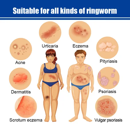 كريم التهاب الجلد والحكة والصدفية