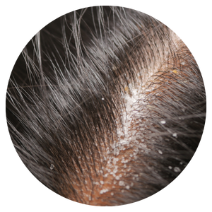 Cuir chevelu irrité