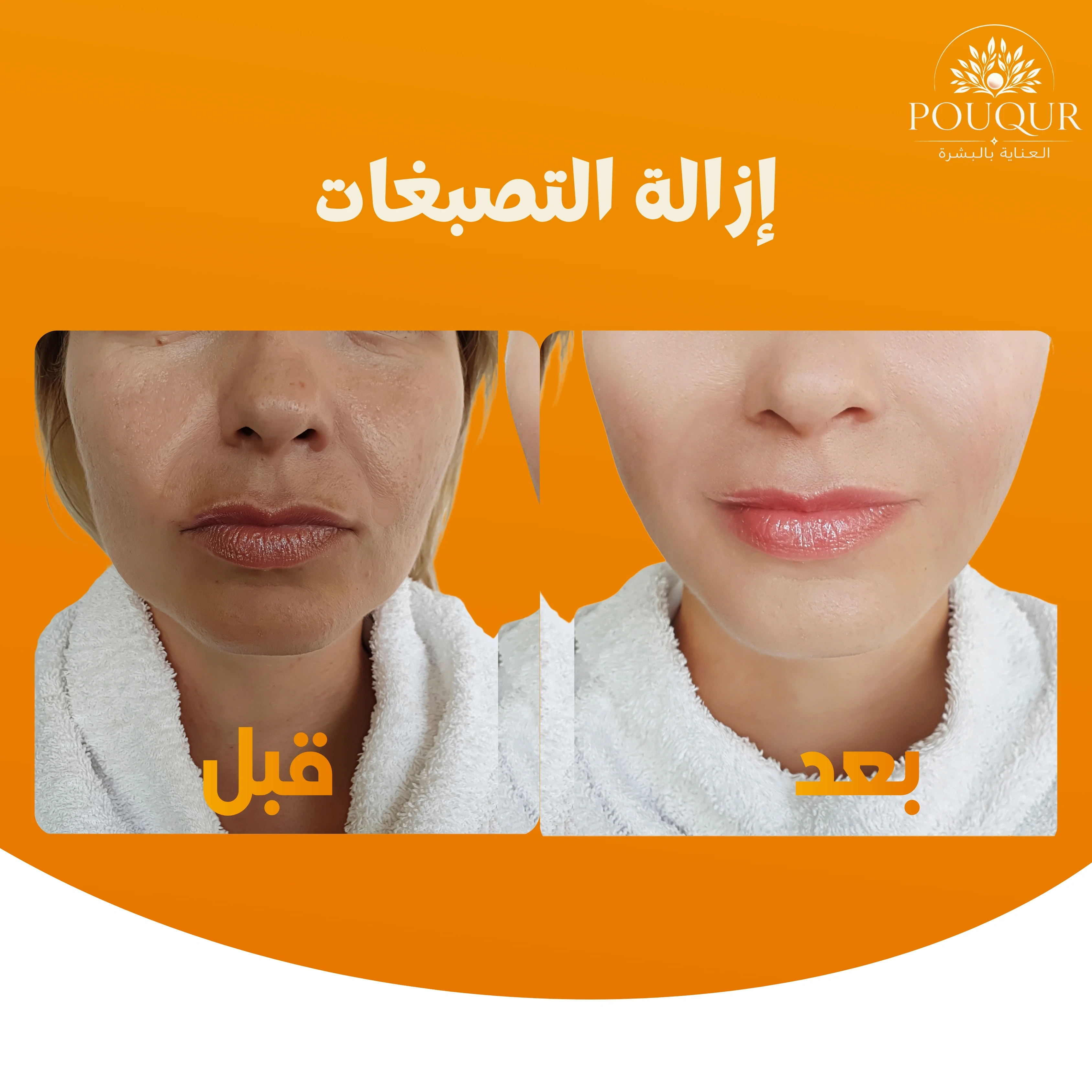 إزالة التصبغات