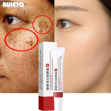 Whitening Cream For Freckles, Melasma Removal, Dark Spots, Melasma, Lighten Skin, Anti Aging