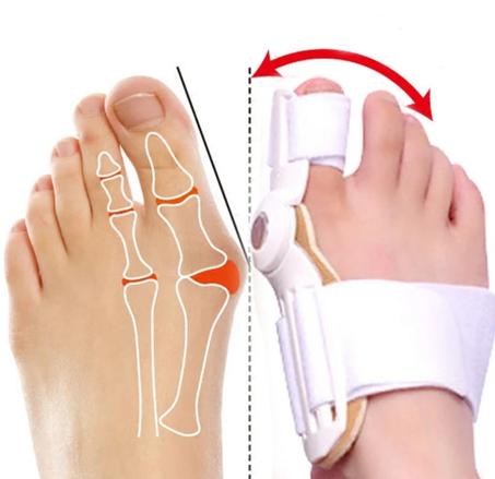 مصحح وضعية ابهام القدم