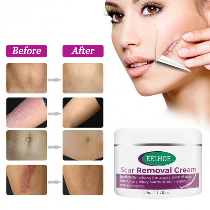 Magic scar removal cream