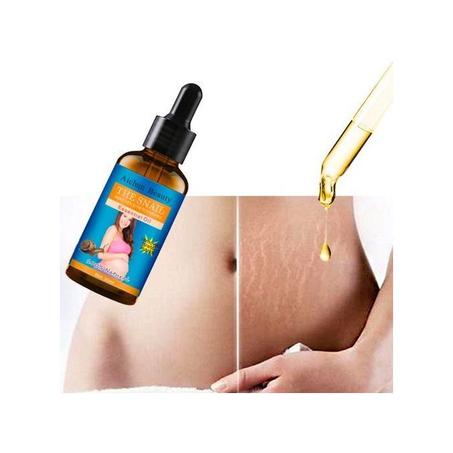 Aichun Beauty Huile d'escargots pour massage pour les vergetures utilisé au corps ventre et hanches