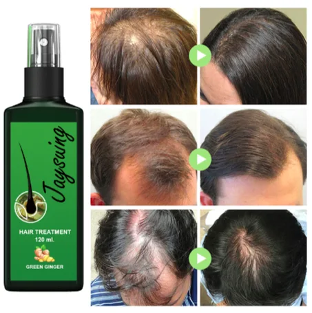 زيت علاج تساقط الشعر