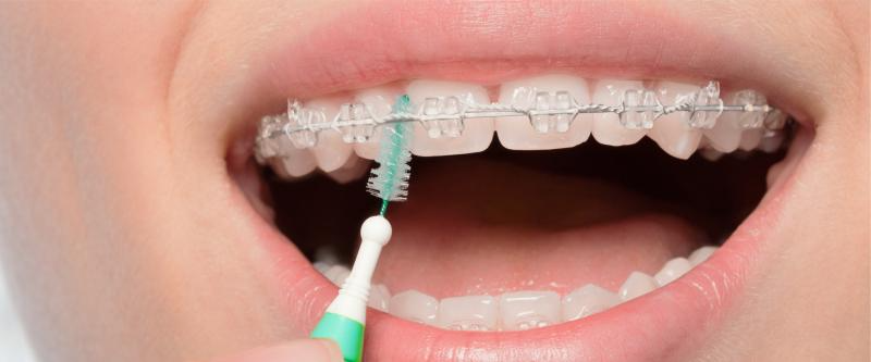 A girl uses the interdental brush to clean her metal braces