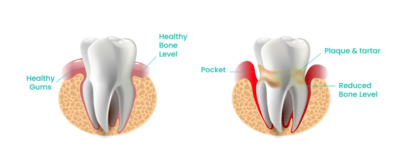 Healthy gums and bones vs unhealthy gums and bone due to good oral hygiene vs poor oral hygiene