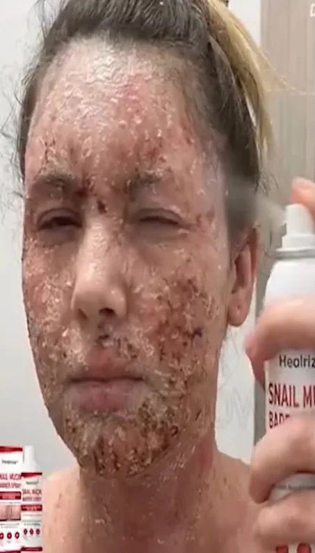 الدوا ديال الإكزيمة اللي عندنا راه رشاشة Spray ساهلة فالاستعمال بزاف.