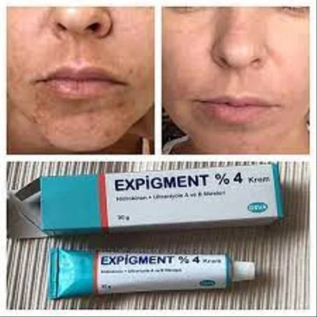 Expigment créme pour visage 4%