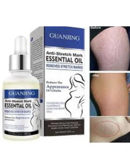 كريم التشققات الجلدية الحمراء والبيضاء  STRETCH MARKS   GUANJING