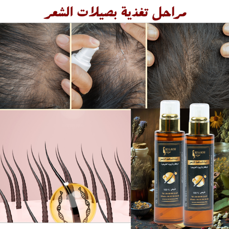 العلاج الطبيعي لتساقط الشعر والتهاب فروة الرأس،تغذية صحية للشعر المتقصف والمتضرر  REVA ROSE   ملم100