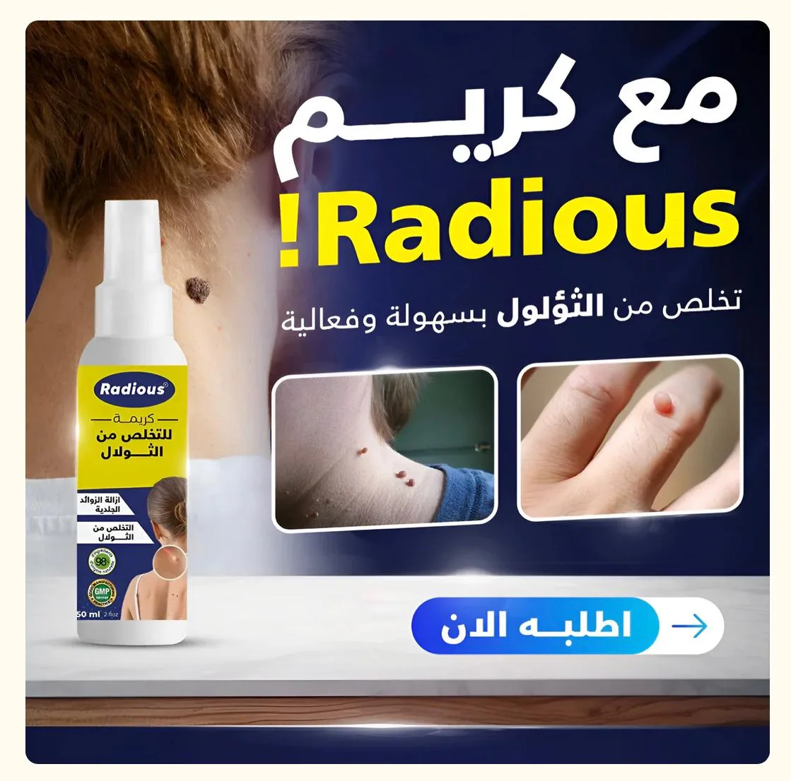 RADIOUS تخلص من الثولال بسهولة و فعالية
