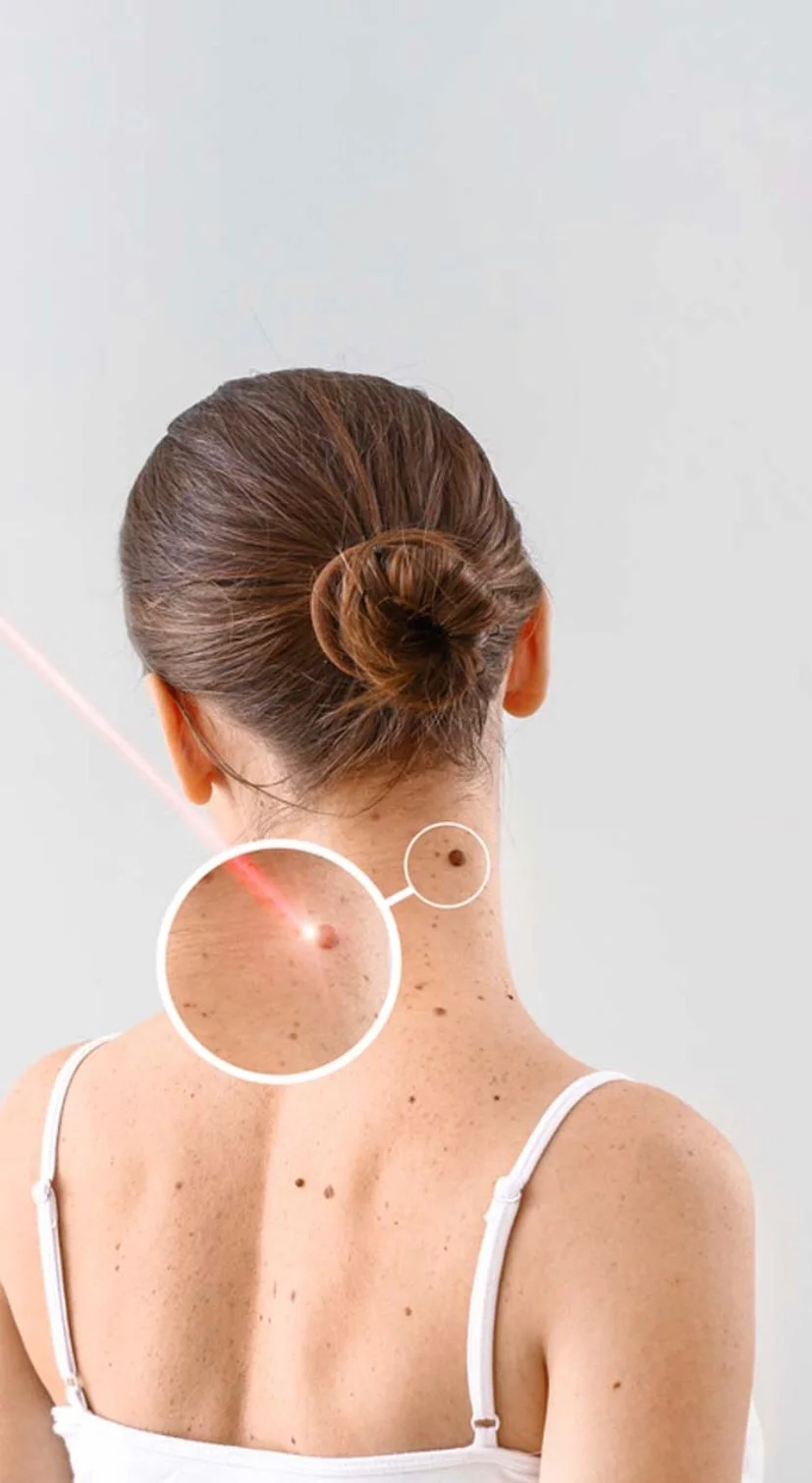 RADIOUS تخلص من الثولال بسهولة و فعالية