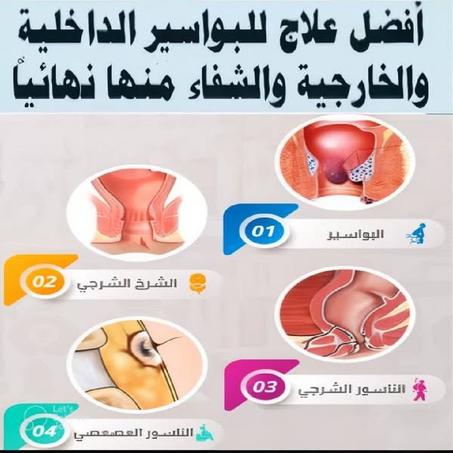 مشروب علاج البواسير الطبيعي