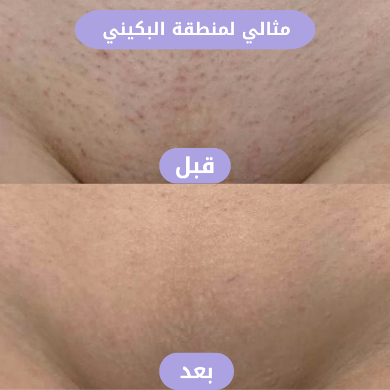 ممحاة ازالة الشعر الكريستالية