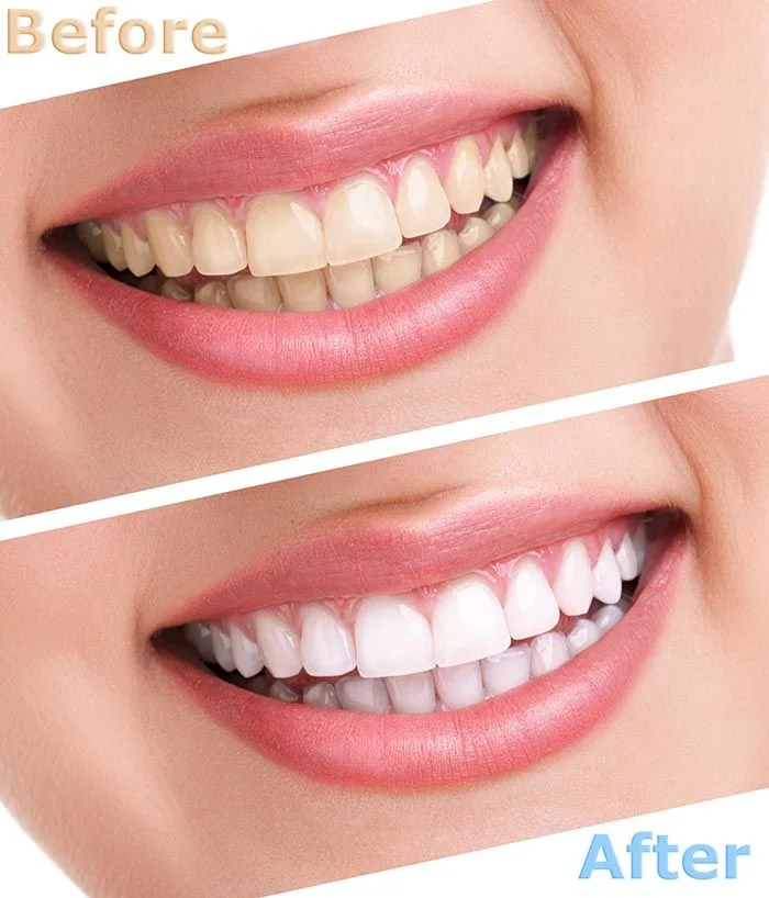 Probiotics Whitening ( rend les dents blanc et élimine les tâtes jaune )