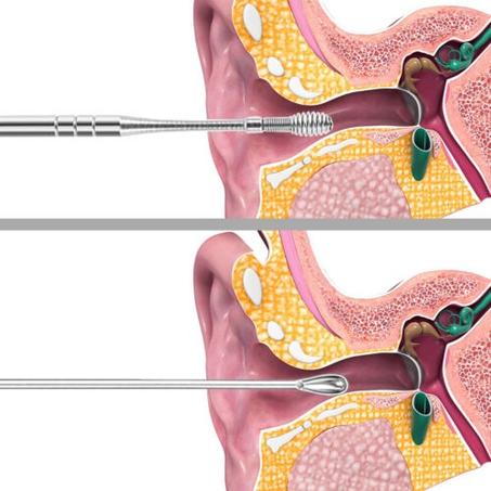 طقم تنظيف شمع الأذن