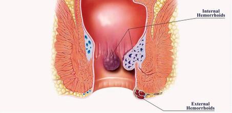 صابون بواسير