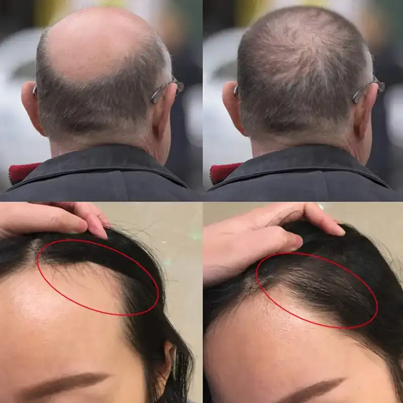 زيت مضاد لتساقط الشعر مع الكافيين