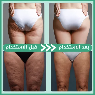 جهاز التدليك المضاد للسيلوليت – لبشرة أنعم وجسم مشدود والثقة بالنفس
