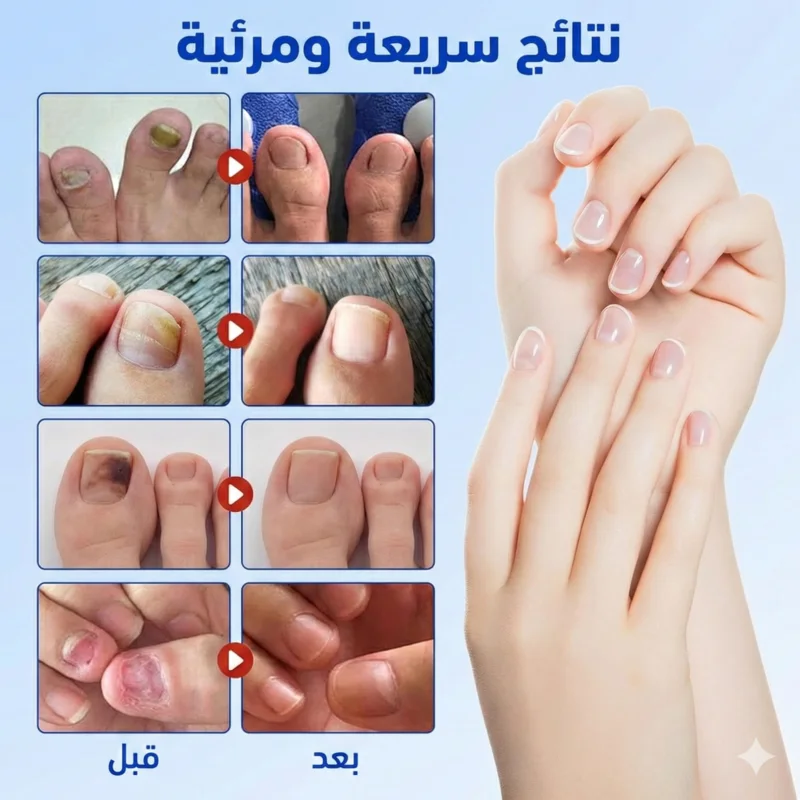 لاصقات الهيدروجيل الطبية لعلاج وإصلاح الأظافر (عبوة 21 لاصقة)