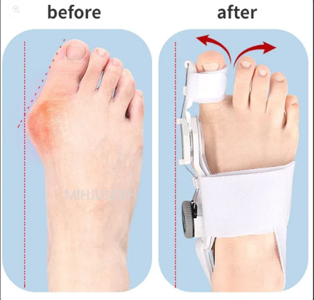 Correcteur Orthopédique pour Hallux Valgus