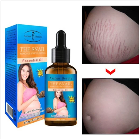 ESSENTIAL OIL - زيت علاج خطوط وتشققات الجسم