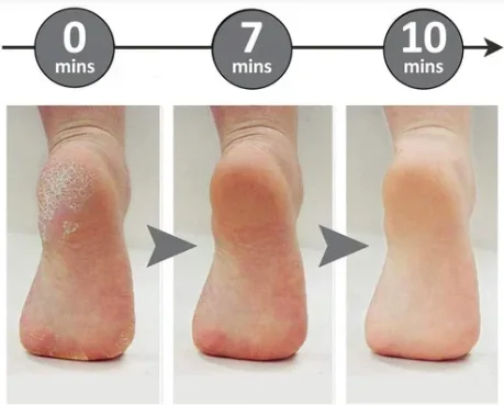 Electronic pédicure tool