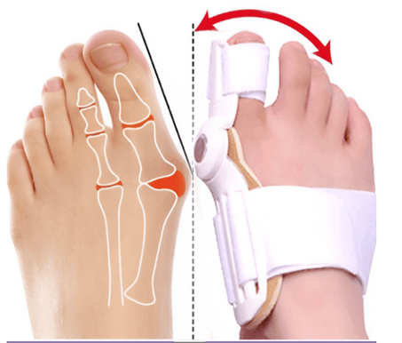 مصحح إبهام القدم (2 قطع)
