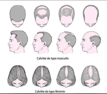 ALOPECIE