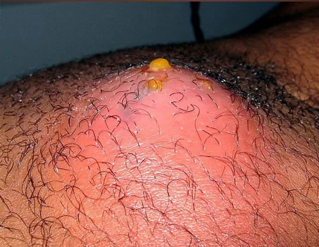 ABCES CUTANE DE LA PEAU