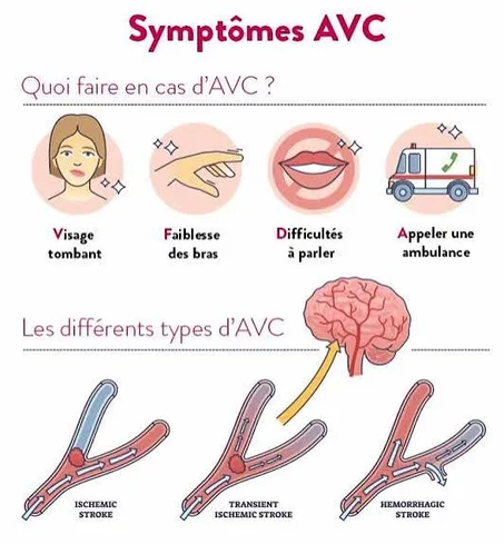 ACCIDENT VASCULAIRE CEREBRAL