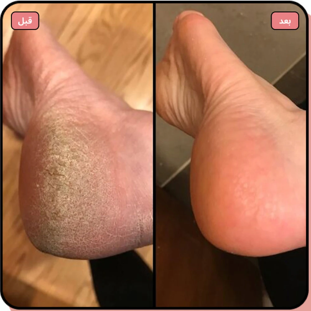 SoftSteps™_ جهاز إزالة الجلد الميت الكهربائي-الدفع عند الاستلام في ليبيا