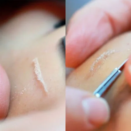 ديرما بلانينج - Derma Planning