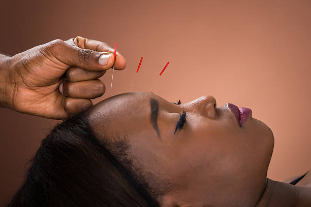 52 Acupuncture Spa Treatment Black Women Stock Photos, Pictures & Royalty-Free Images - iStock