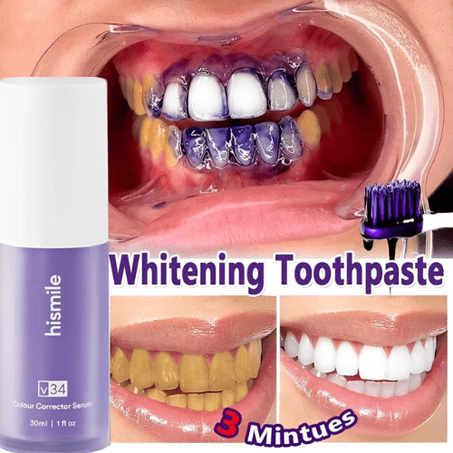 Hismile V34 Teeth Whitening Kit | Professional Results at Home | FREE Delivery Tanzania