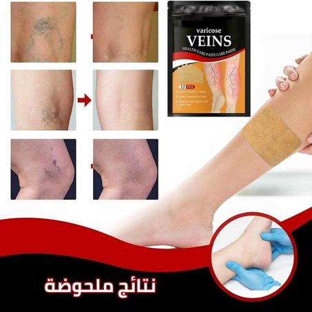 لاصقات علاج الدوالي آمنة,     "لا داعي للجراحة بعد اليوم"