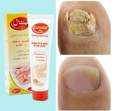 كريم علاج فطريات الاظافر
