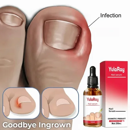 زيت علاج الظفر الناشب