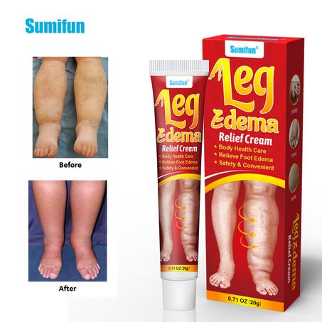 CREME CONTRE LES OEDEMES ET GONFLEMENT DES JAMBES