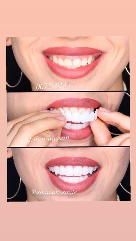 SNAP ON SMILE (SOLD )