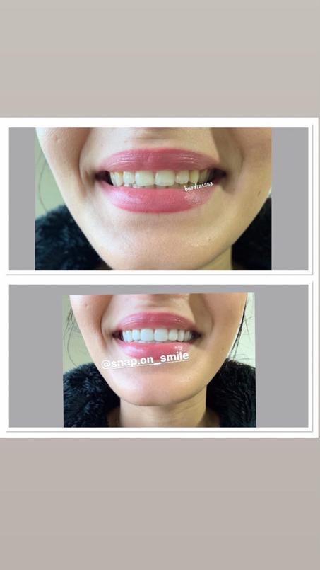 impression kit + smile (upper and lower)