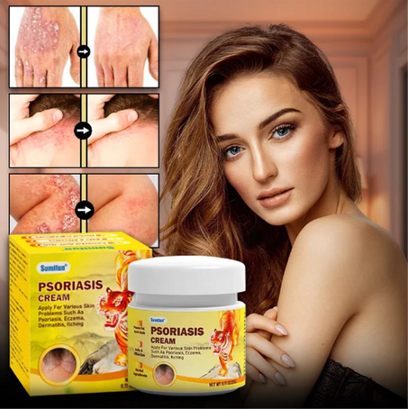 كريم علاج الصدفية والأكزيما